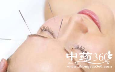 针灸的好方法