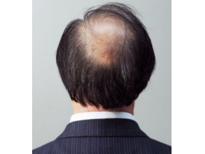 地中海脱发影响男人颜值 四招应对地中海脱发