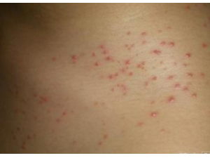 ����ò��� ͨ��Ƥ����ָ�׵ı仯������״��