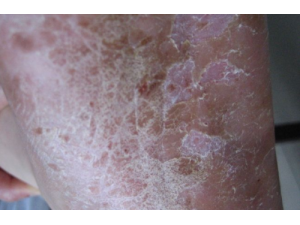 ����ʪ������Ʒ��� ��ҽ�����������ʪ��