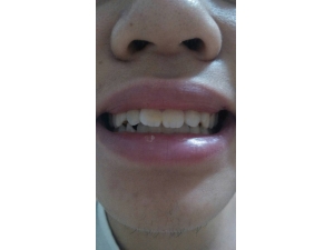 ������Ѫ��ԭ�� ����������Ѫ�ķ���