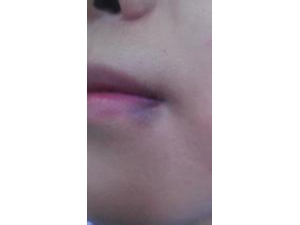 �촽������ʲôԭ�� �촽���ϵĽ���취