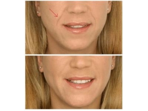 法令纹怎么消除 中医按摩抗皱效果好