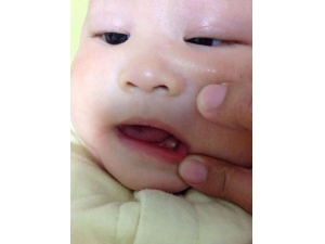 ���ػ׳没��֢״ �������ƻ׳没�ķ���