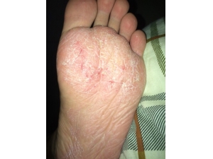 �ŵ���Ƥ��ô�� ����ƫ������Ч����