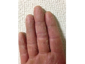 冬天手剥皮是怎么回事 可采取五大处理办法