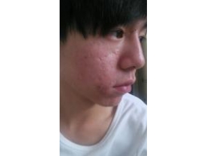 ȥ�������6��ƫ�� ����ȥ����ķ���