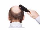 6个治疗脱发的办法，男女必学